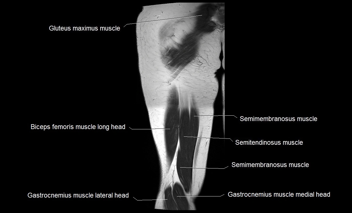 MRI thigh coronal cross sectional anatomy image 20.webp